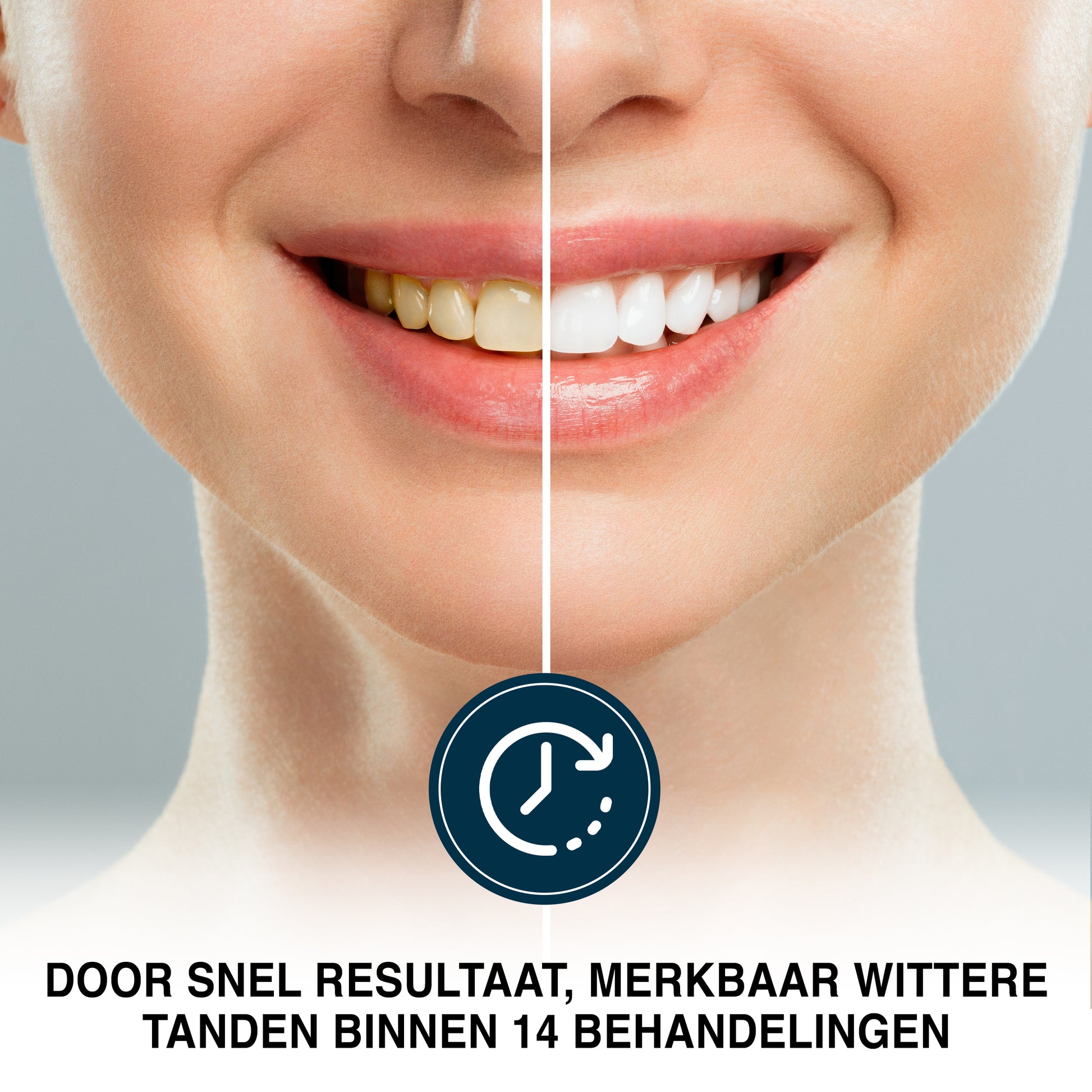 Voor en na resultaat met PurelyGoods tandenbleekstrips – merkbaar wittere tanden na 14 behandelingen